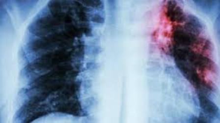 OMS pré-qualifica primeiro teste de diagnóstico da tuberculose